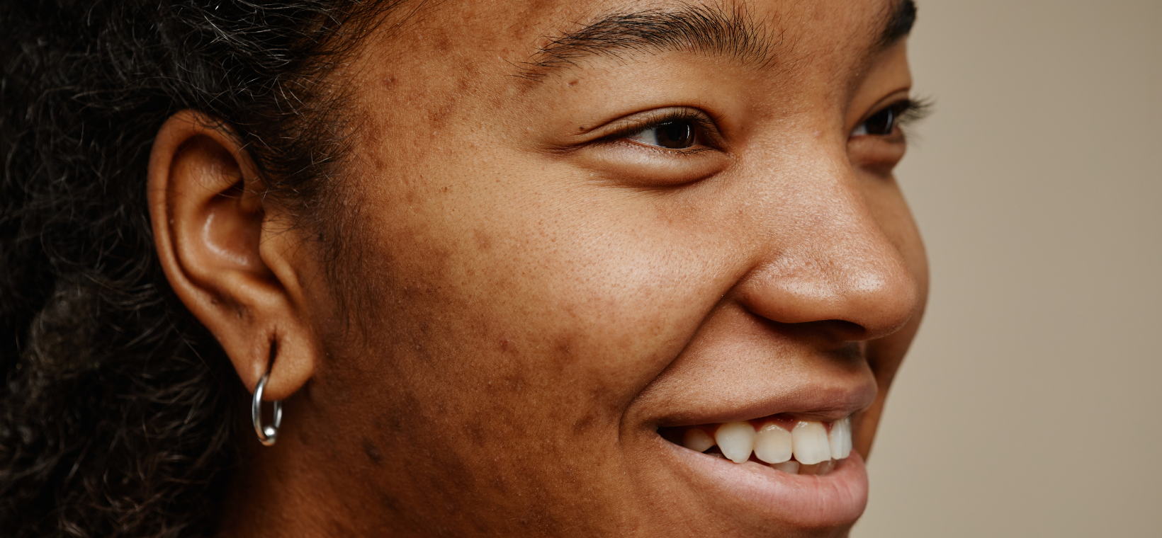 Visuel d'une femme à la peau grasse avec de l'acné