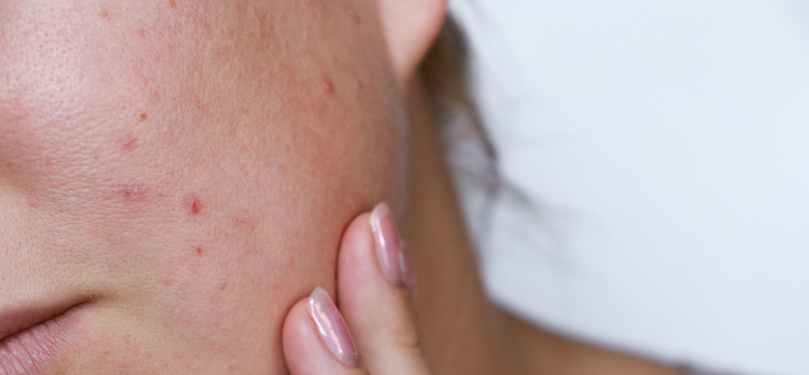 Visuel d'une femme à la peau grasse avec de l'acné